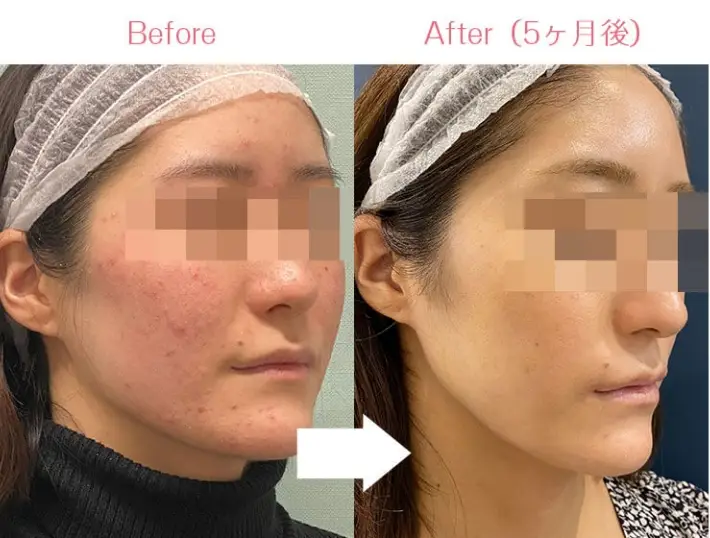 BEAUTY SKIN CLINIC(ビューティースキンクリニック) 治療例