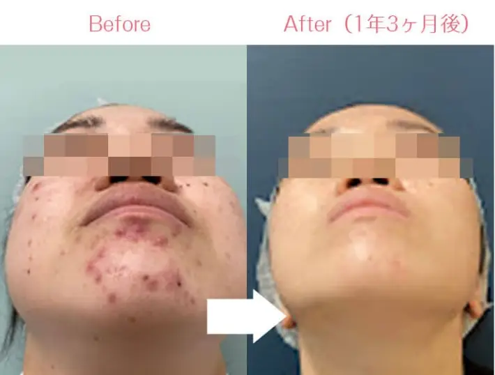 BEAUTY SKIN CLINIC(ビューティースキンクリニック) 治療例