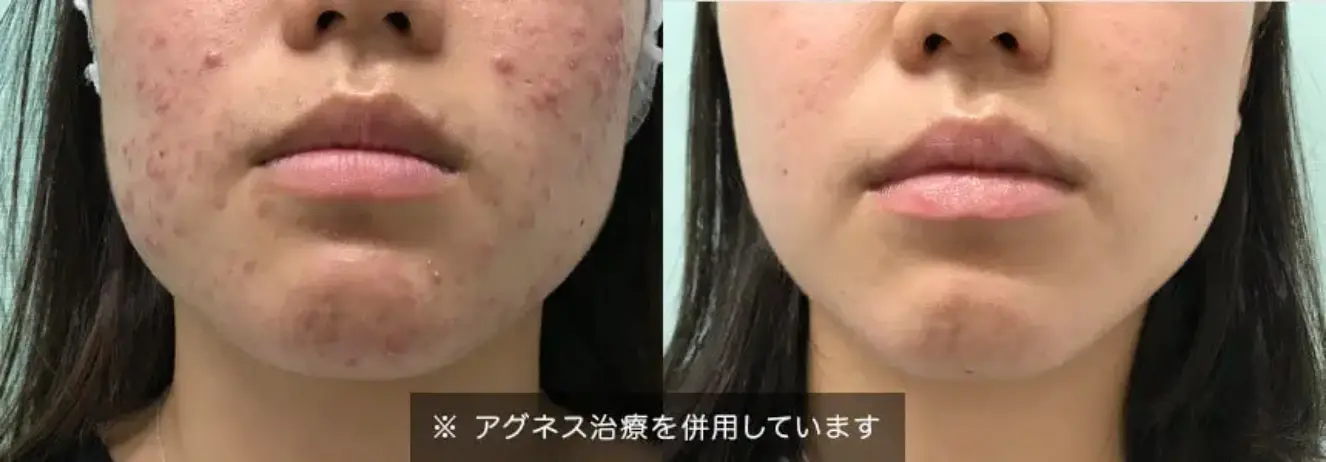 BEAUTY SKIN CLINIC（ビューティースキンクリニック） イオン導入