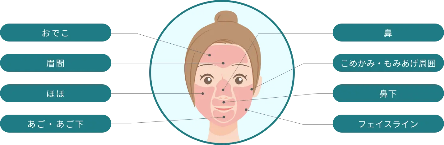 BEAUTY SKIN CLINIC（ビューティースキンクリニック） 全顔医療脱毛セット