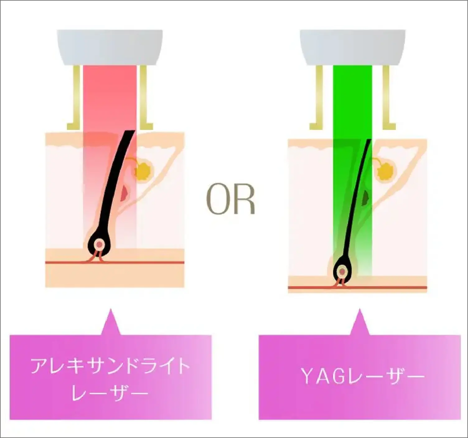 BEAUTY SKIN CLINIC（ビューティースキンクリニック） 最新型ジェントルマックスプロプラス