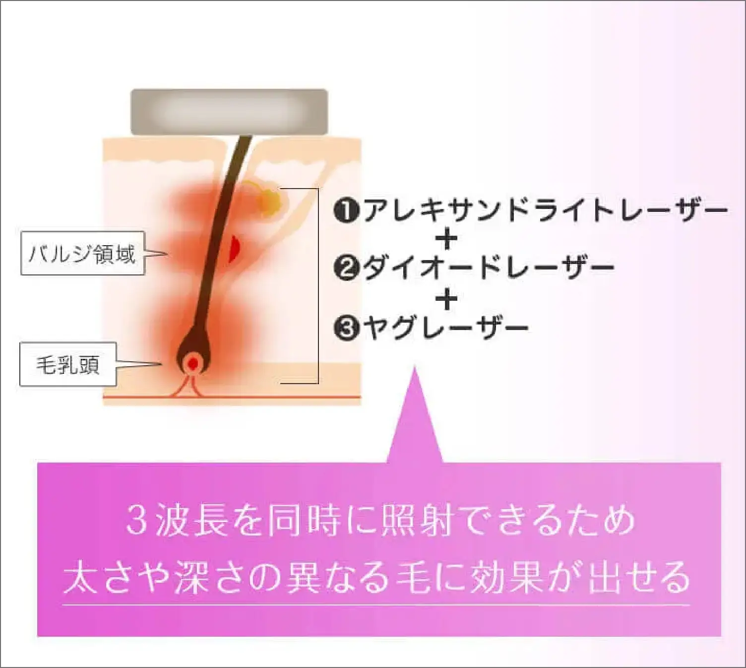 BEAUTY SKIN CLINIC（ビューティースキンクリニック） 最新型ジェントルマックスプロプラス