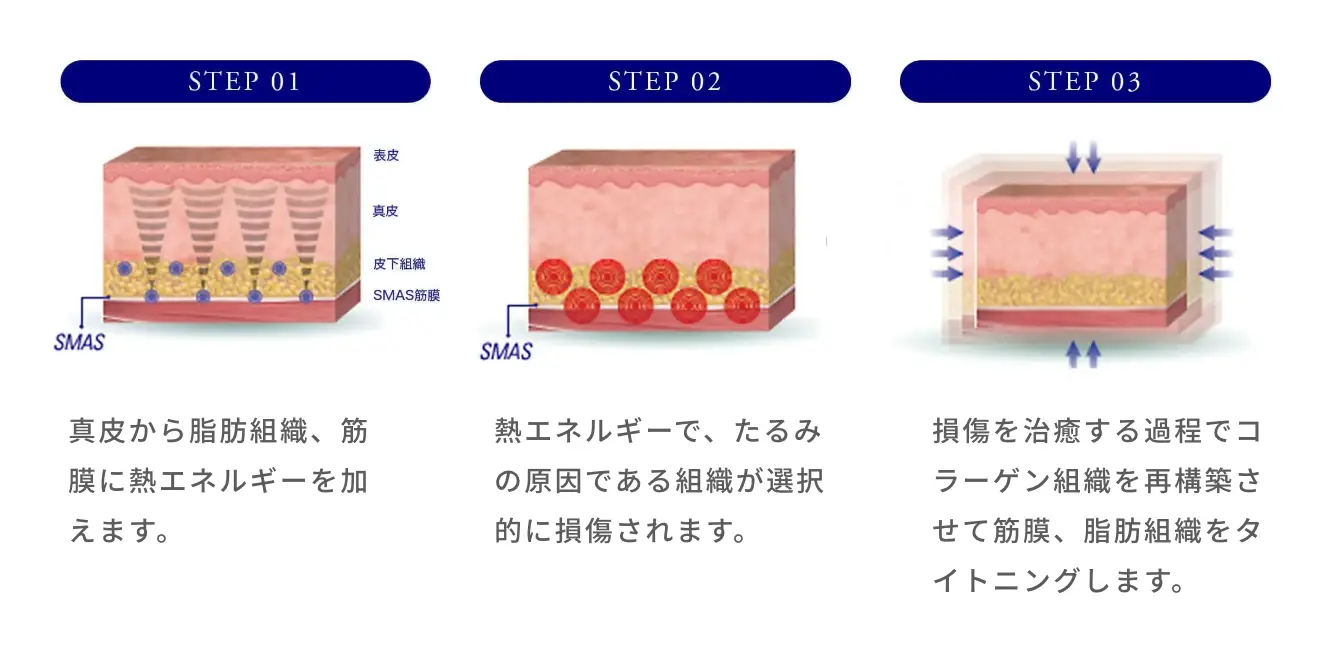 BEAUTY SKIN CLINIC（ビューティースキンクリニック） HIFU ウルトラセルQプラス