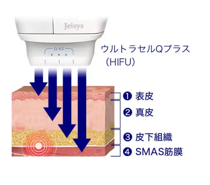 BEAUTY SKIN CLINIC（ビューティースキンクリニック） HIFU ウルトラセルQプラス