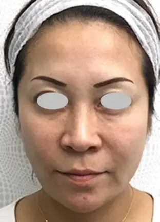 BEAUTY SKIN CLINIC(ビューティースキンクリニック) ヒアルロン酸注射