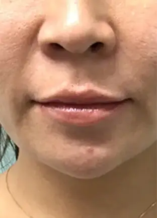 BEAUTY SKIN CLINIC(ビューティースキンクリニック) ヒアルロン酸注射