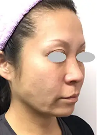 BEAUTY SKIN CLINIC(ビューティースキンクリニック) ヒアルロン酸注射