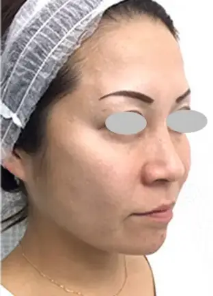 BEAUTY SKIN CLINIC(ビューティースキンクリニック) ヒアルロン酸注射