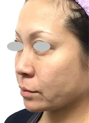 BEAUTY SKIN CLINIC(ビューティースキンクリニック) ヒアルロン酸注射