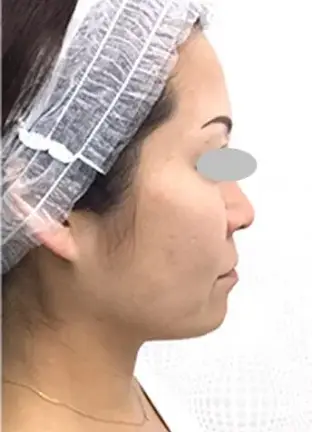 BEAUTY SKIN CLINIC(ビューティースキンクリニック) ヒアルロン酸注射