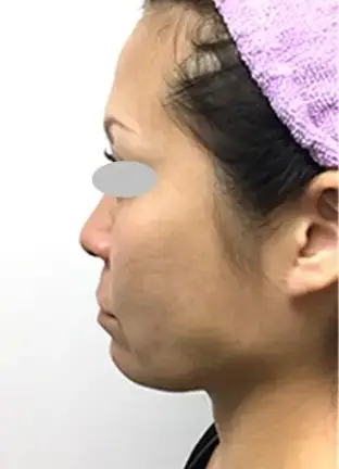 BEAUTY SKIN CLINIC(ビューティースキンクリニック) ヒアルロン酸注射