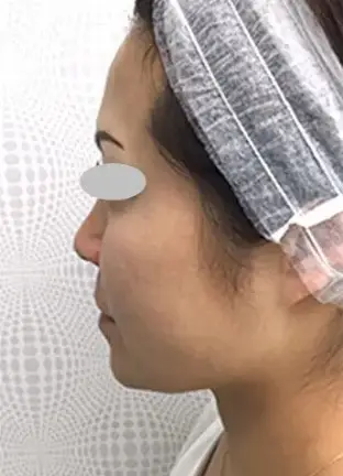 BEAUTY SKIN CLINIC(ビューティースキンクリニック) ヒアルロン酸注射