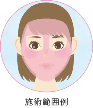 BEAUTY SKIN CLINIC（ビューティースキンクリニック） リジュラン（ジュベルック）×水光注射