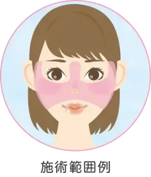 BEAUTY SKIN CLINIC（ビューティースキンクリニック） リジュラン（ジュベルック）×水光注射