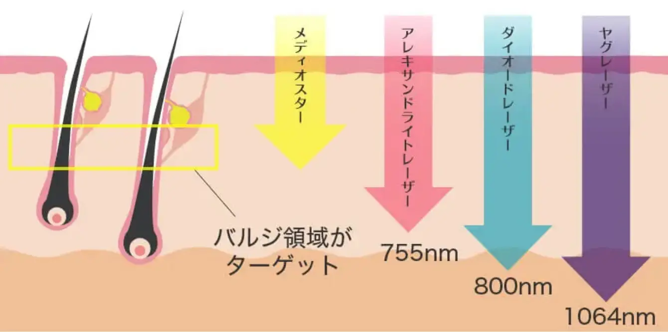 4種類の脱毛機を併用するメリット