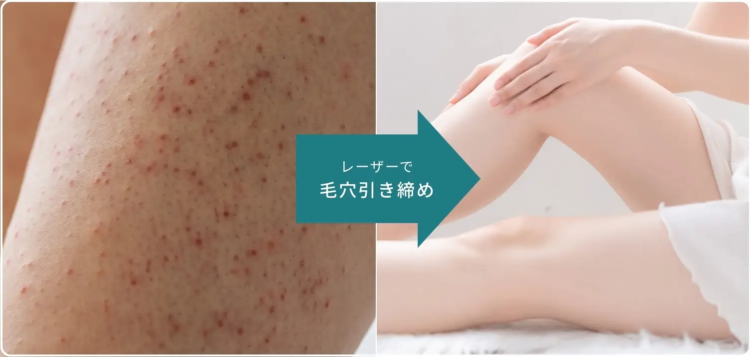 BEAUTY SKIN CLINIC（ビューティースキンクリニック） 脚医療脱毛セット