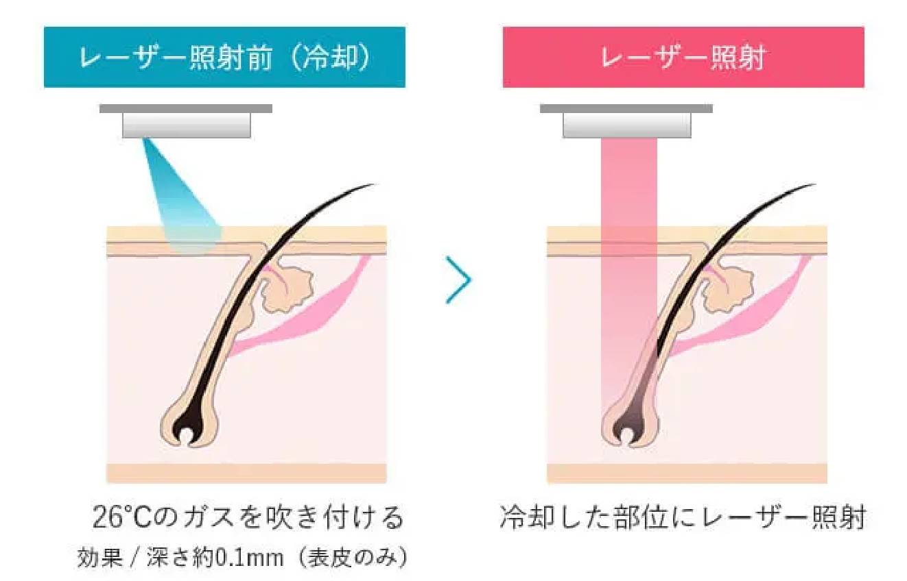 BEAUTY SKIN CLINIC（ビューティースキンクリニック） ジェントルマックスプロ