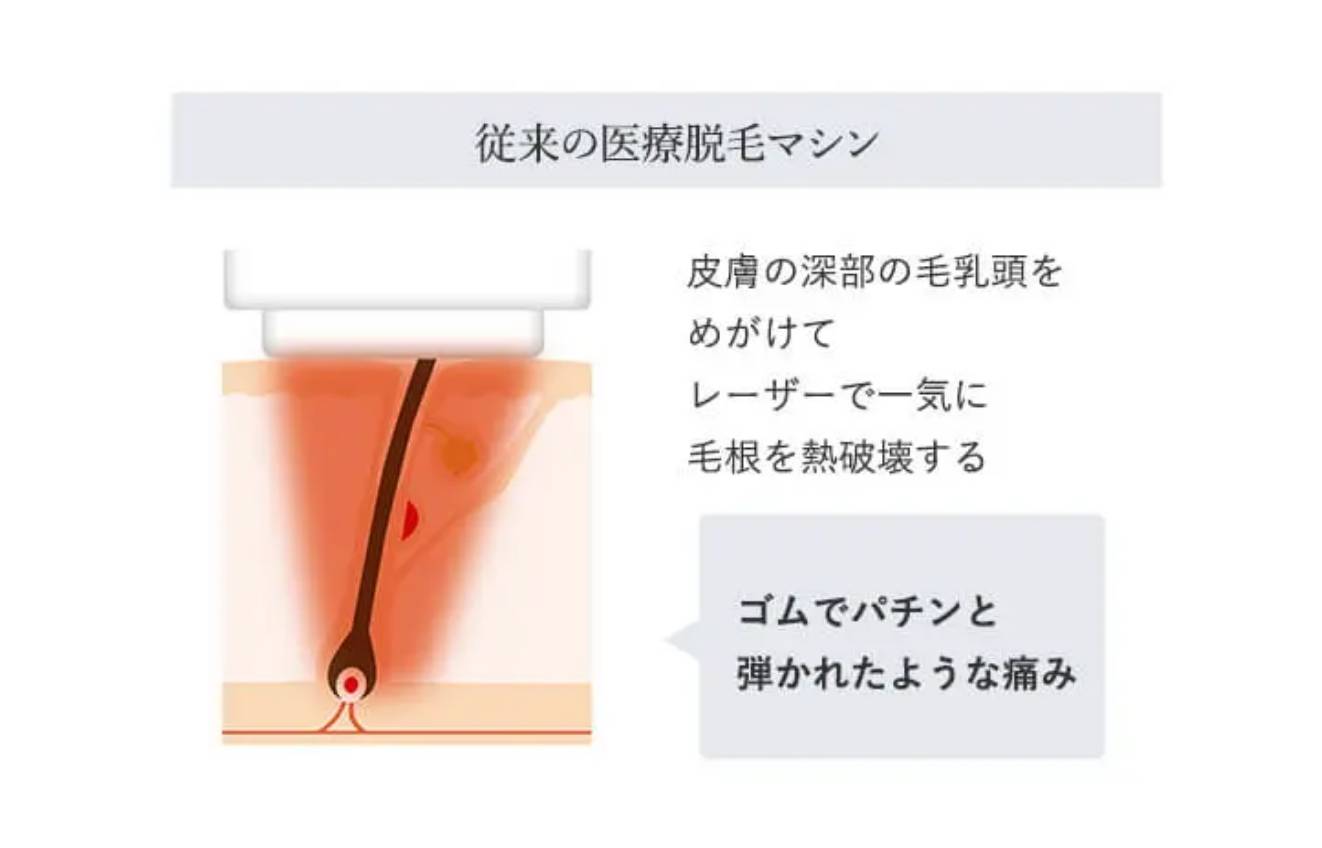 BEAUTY SKIN CLINIC（ビューティースキンクリニック） メディオスターNEXT PRO