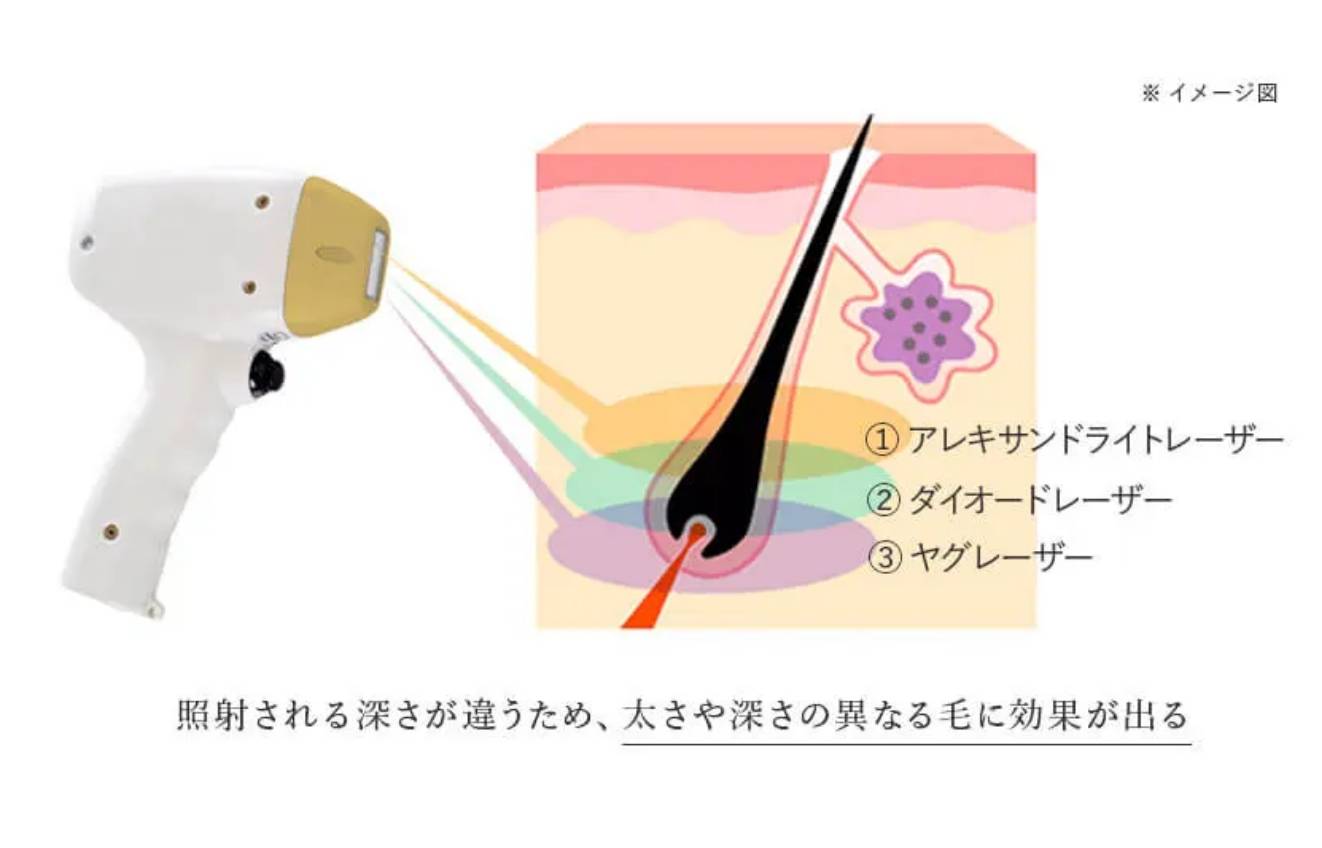 BEAUTY SKIN CLINIC（ビューティースキンクリニック） ソプラノチタニウム