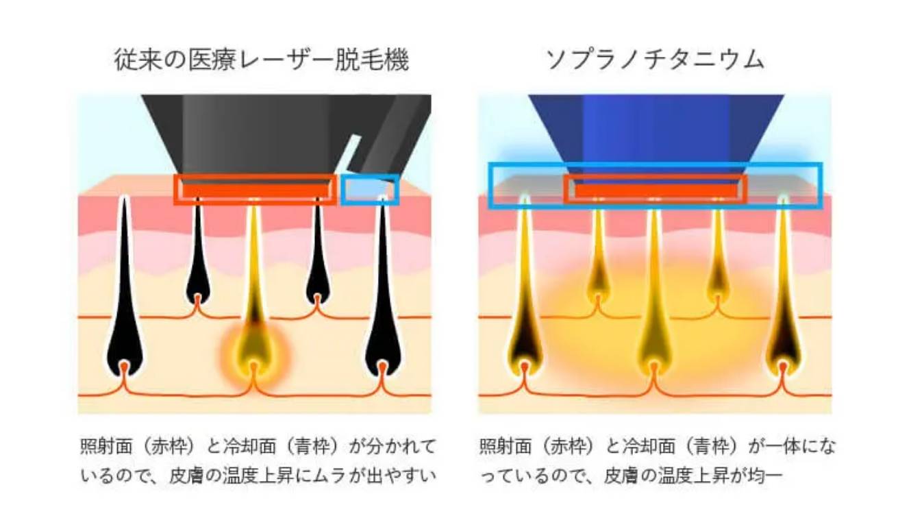 BEAUTY SKIN CLINIC（ビューティースキンクリニック） ソプラノチタニウム