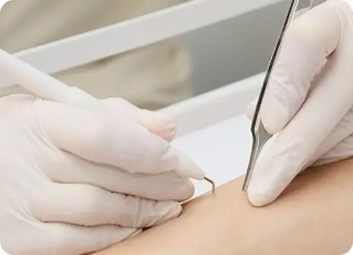 BEAUTY SKIN CLINIC（ビューティースキンクリニック） ニードル脱毛（医療針脱毛）