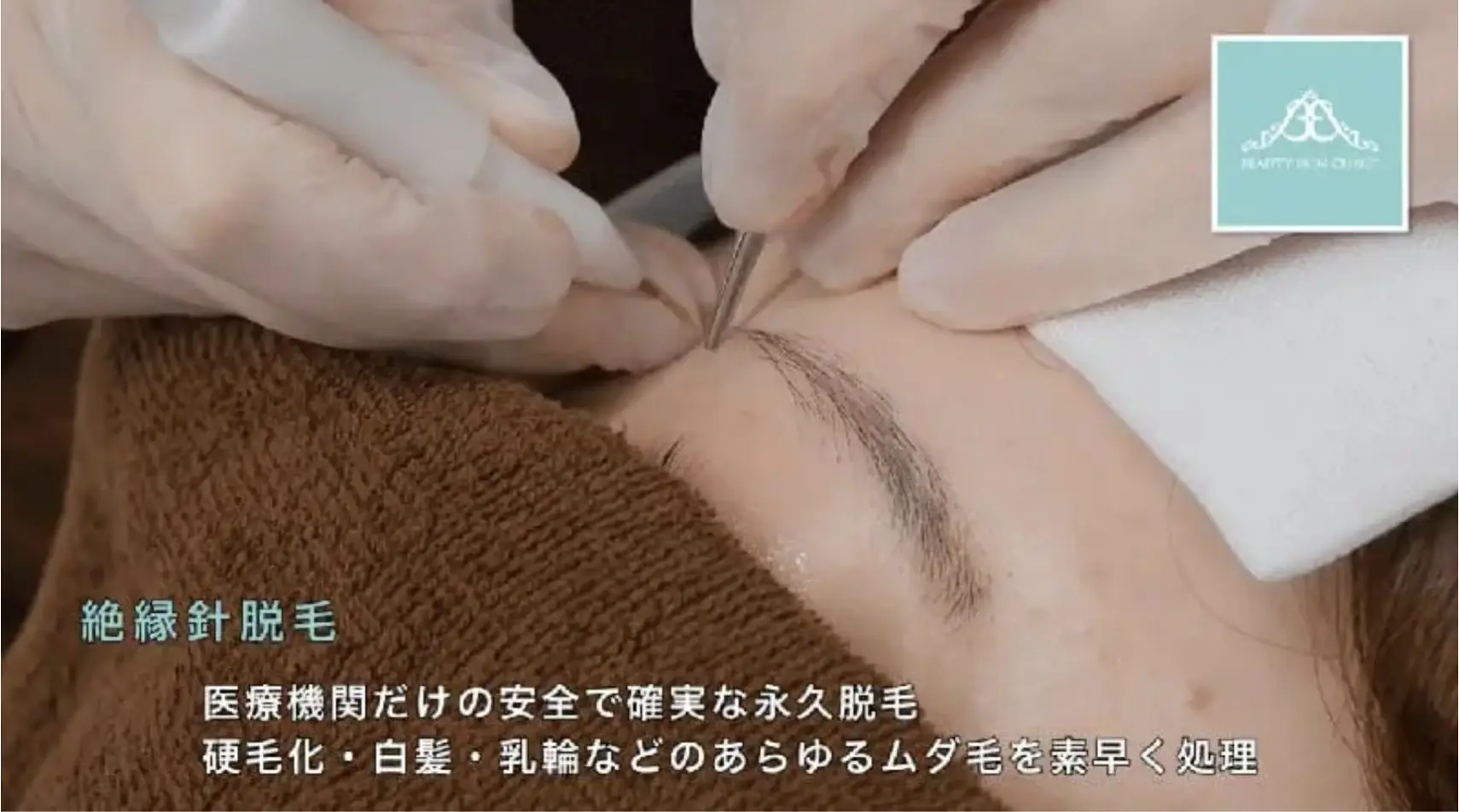 BEAUTY SKIN CLINIC（ビューティースキンクリニック） ニードル脱毛（医療針脱毛）