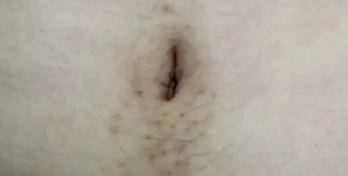 BEAUTY SKIN CLINIC（ビューティースキンクリニック） ニードル脱毛（医療針脱毛）