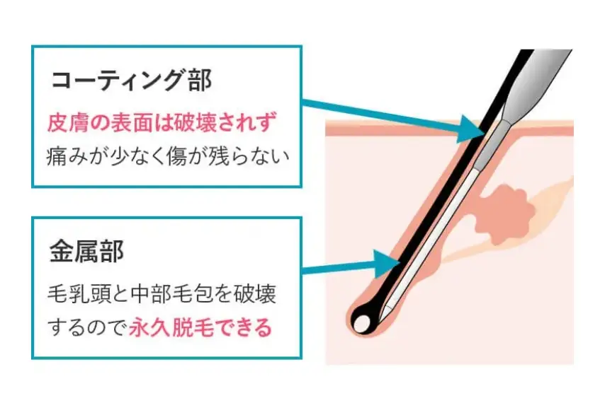 BEAUTY SKIN CLINIC(ビューティースキンクリニック) ニードル脱毛(医療針脱毛)