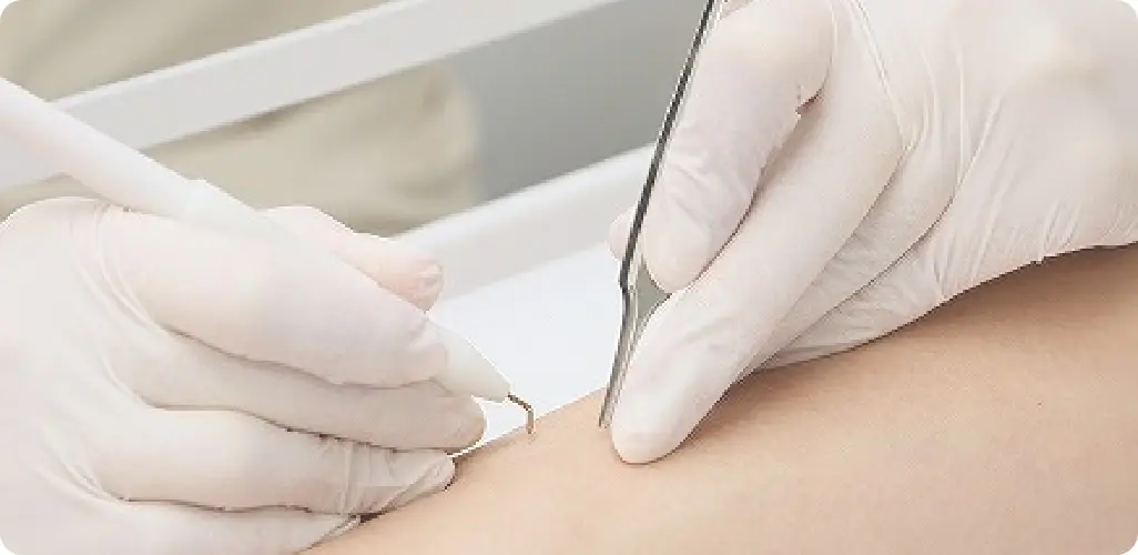 BEAUTY SKIN CLINIC（ビューティースキンクリニック） ニードル脱毛（医療針脱毛）