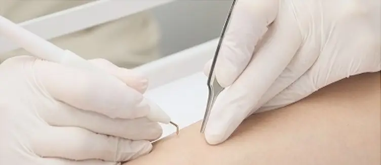 BEAUTY SKIN CLINIC（ビューティースキンクリニック） ニードル脱毛（医療針脱毛）