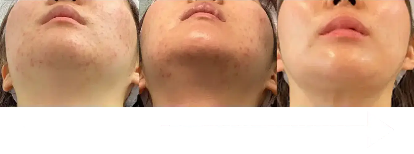 BEAUTY SKIN CLINIC（ビューティースキンクリニック） ニキビ治療完全オーダーメードプラン