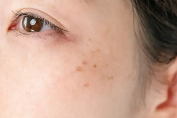 BEAUTY SKIN CLINIC(ビューティースキンクリニック)最新機種 ピコシュアプロ