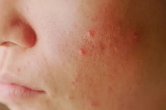 BEAUTY SKIN CLINIC(ビューティースキンクリニック)最新機種 ピコシュアプロ