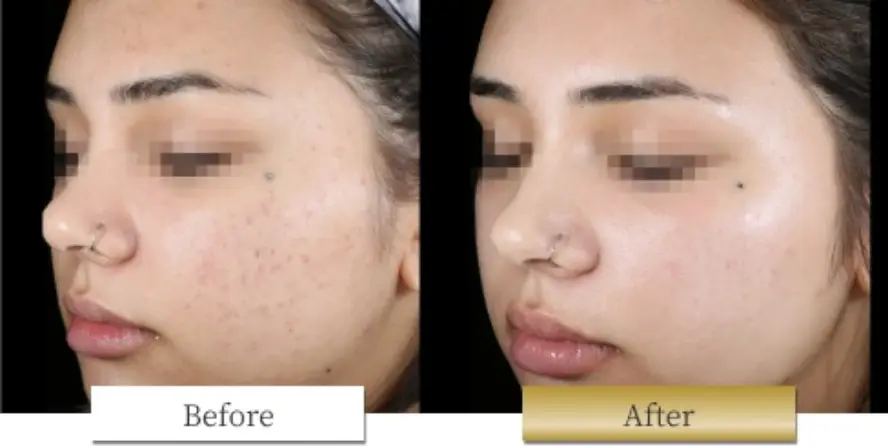 ピコシュアの副作用・リスク