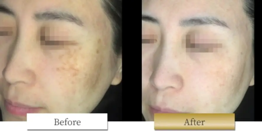 ピコシュアの副作用・リスク