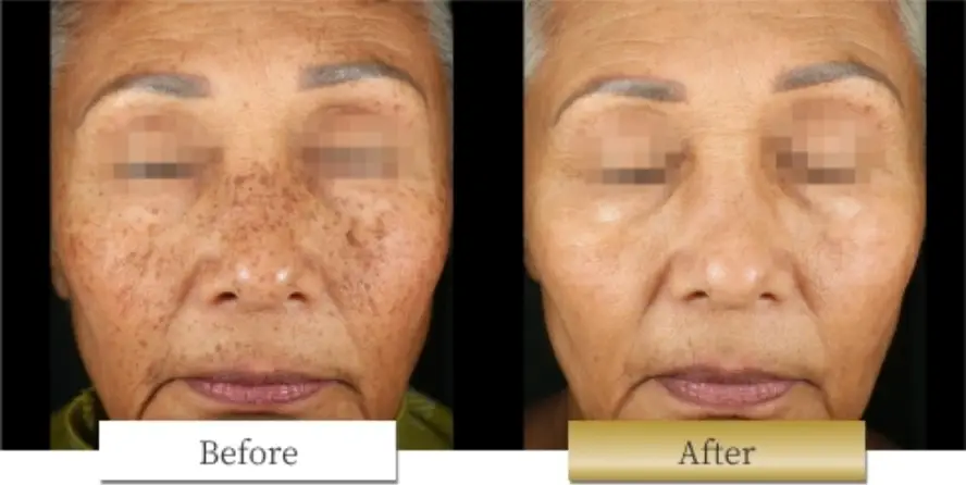 ピコシュアの副作用・リスク