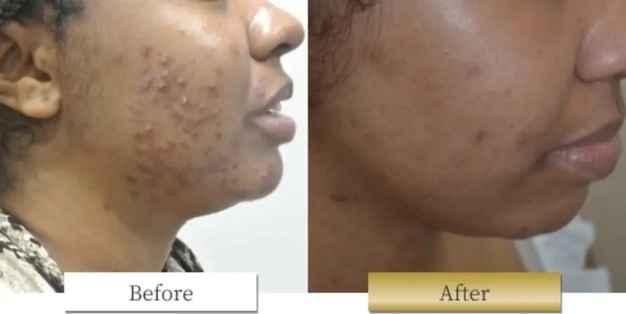 ピコシュアの副作用・リスク