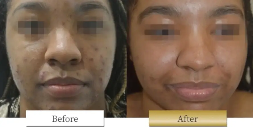 ピコシュアの副作用・リスク