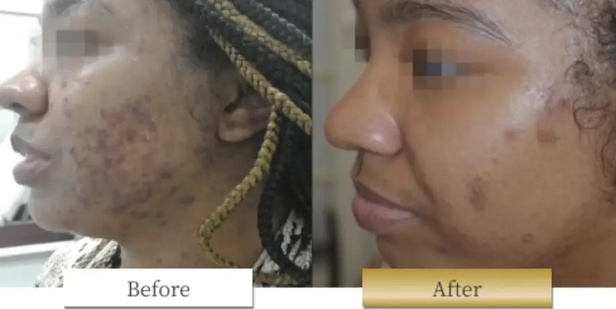 ピコシュアの副作用・リスク