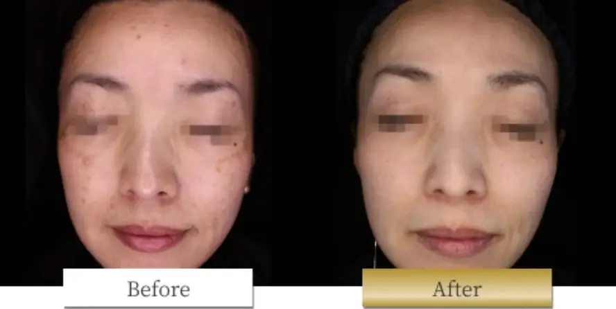 ピコシュアの副作用・リスク