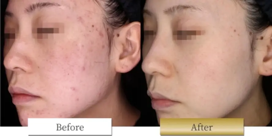 ピコシュアの副作用・リスク