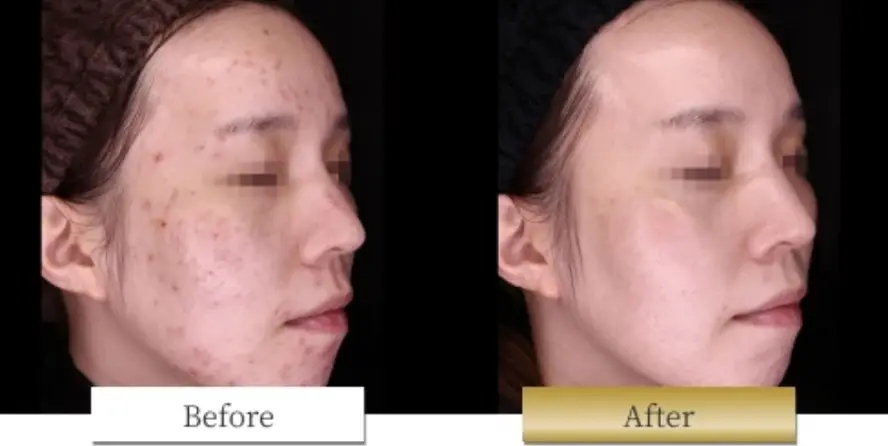 ピコシュアの副作用・リスク