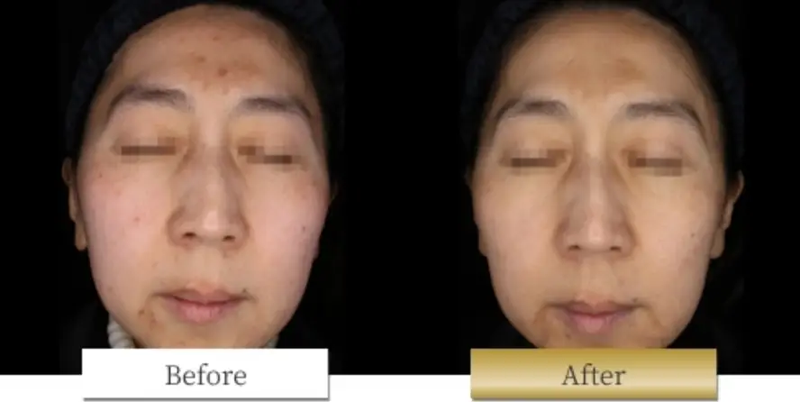 ピコシュアの副作用・リスク