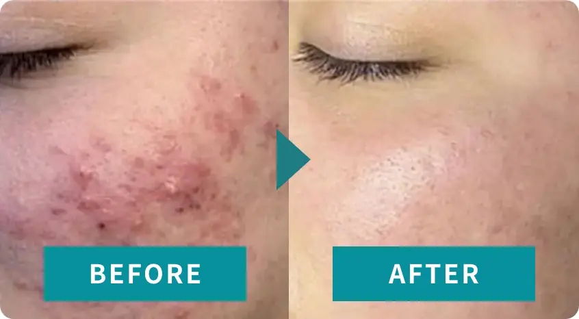 BEAUTY SKIN CLINIC(ビューティースキンクリニック) スーパーヴェルヴェットスキン