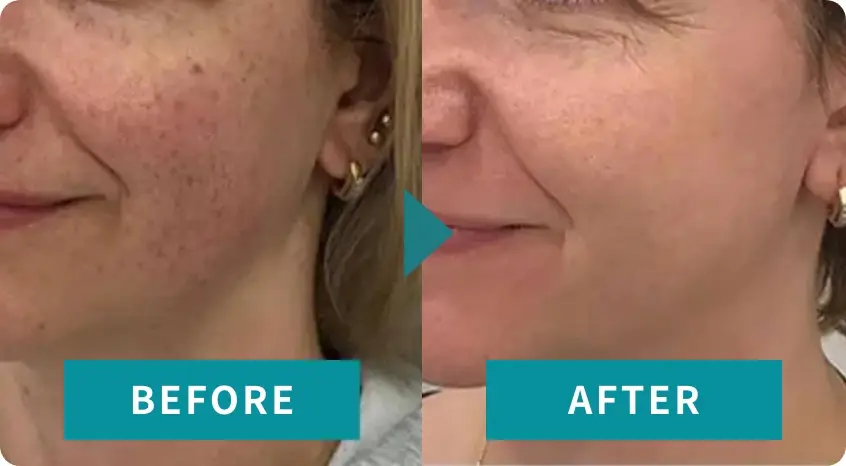 BEAUTY SKIN CLINIC(ビューティースキンクリニック) スーパーヴェルヴェットスキン