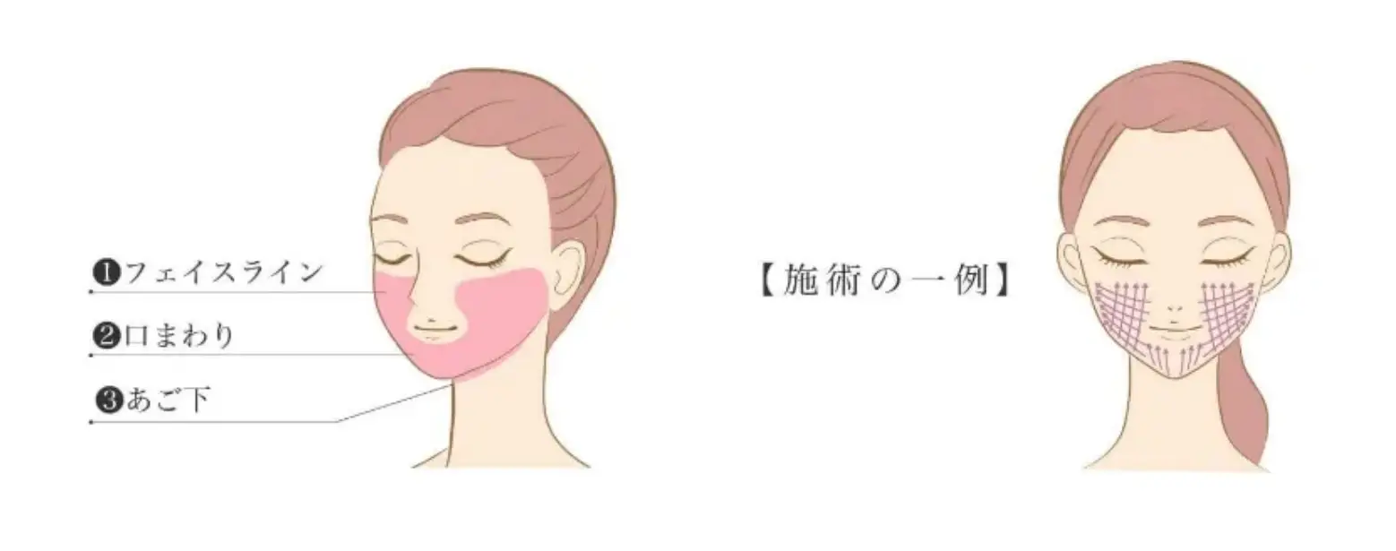 BEAUTY SKIN CLINIC（ビューティースキンクリニック） 糸リフト