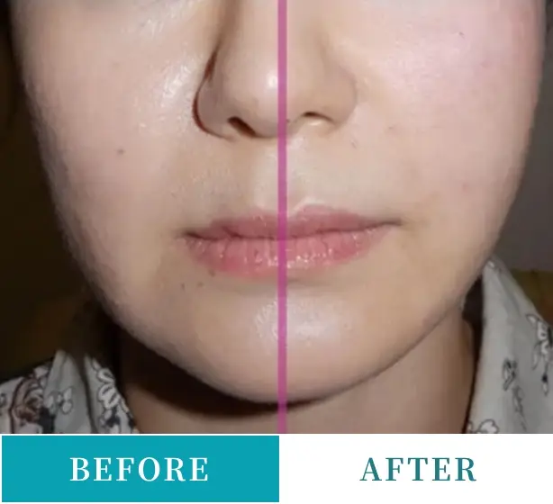 BEAUTY SKIN CLINIC(ビューティースキンクリニック) 糸リフト