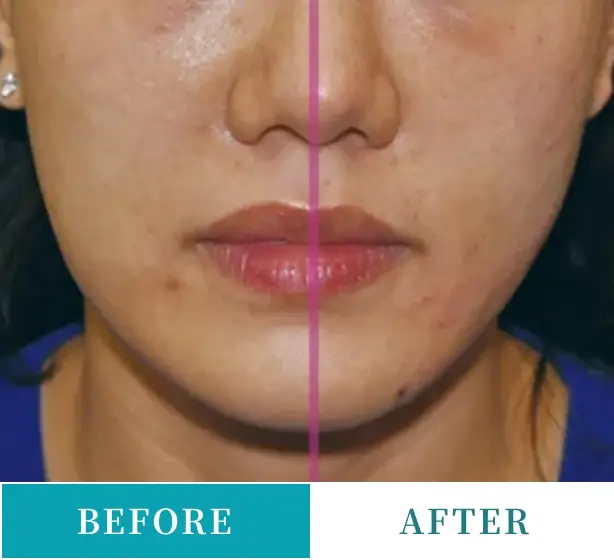 BEAUTY SKIN CLINIC(ビューティースキンクリニック) 糸リフト