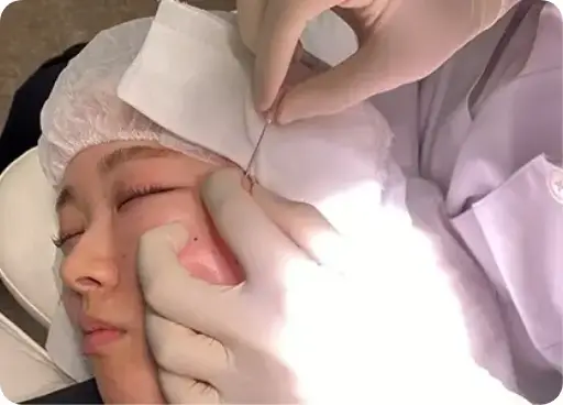 BEAUTY SKIN CLINIC（ビューティースキンクリニック） 糸リフト