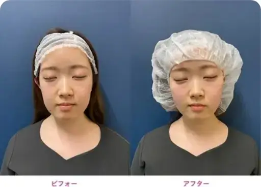 BEAUTY SKIN CLINIC（ビューティースキンクリニック） 糸リフト